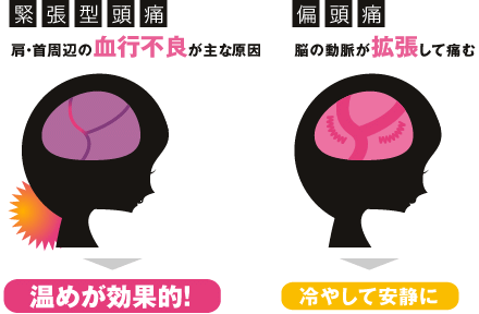 「緊張型頭痛」と「偏頭痛」イメージ図